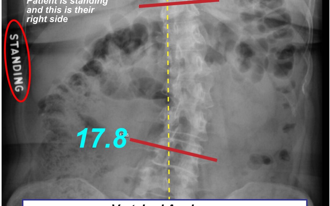 How to read Scoliosis Images